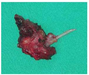 Pieza quir&uacute;rgica con espina de pescado visible