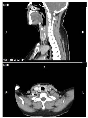 Tomograf&iacute;a computarizada de cuello en la que se visualiza el cuerpo extra&ntilde;o.