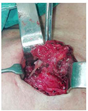 Exploraci&oacute;n cervical abierta en la que se observa la espina de pescado alojada en la gl&aacute;ndula tiroides.