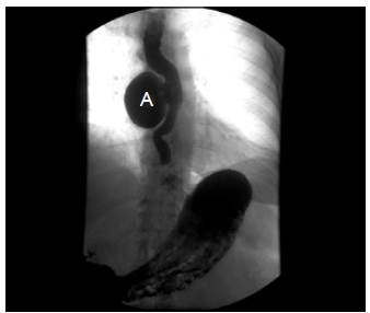 Divertículo esofágico de tercio medio, lateral derecho (A).