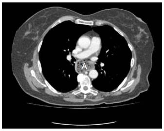 Divertículo esofágico de tercio medio con restos alimentarios en su interior (A).