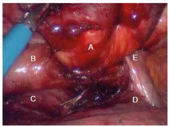 Divertículo (A) y esófago distal (B), en relación anatómica con las venas pulmonares derechas (C), bronquio principal derecho (D) y cayado de la vena ácigos (E).