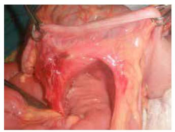 Orificio a trav&eacute;s del cual protru&iacute;a la hernia paracecal.