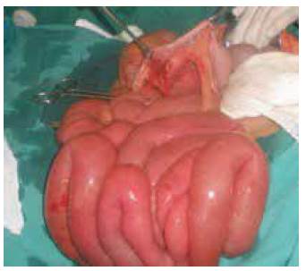 Hernia paracecal: dilataci&oacute;n proximal de asas intestinales
