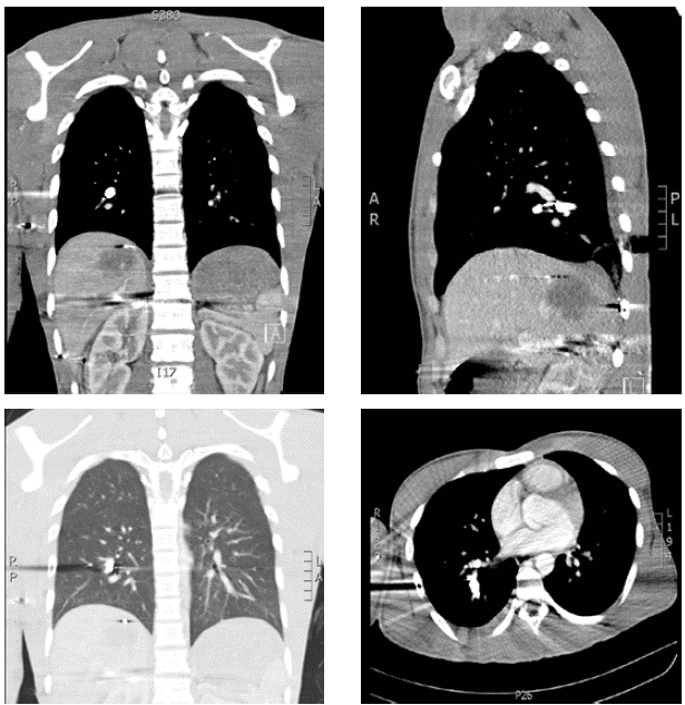 Angiotomografía con énfasis en el pulmón: proyectil de arma de fuego localizado en la arteria pulmonar del lóbulo inferior derecho, embolia pulmonar aguda en ramas para el lóbulo inferior derecho distal al proyectil, y proyectil en los tejidos blandos de la pared torácica posterior derecha, asociado con laceración y contusión pulmonar basal