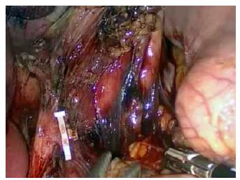 Resultado final de la linfadenectom&iacute;a de la arteria g&aacute;strica izquierda con preservaci&oacute;n de la rama ascendente y ligadura de la rama descendente.