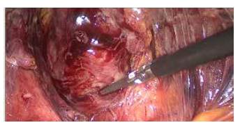 Colecistectom&iacute;a dif&iacute;cil. Las estructuras del tri&aacute;ngulo de Calot, no son identificables. La pinza se&ntilde;ala la bolsa de Hartman.