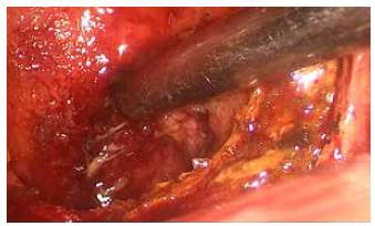 Momento de la cirug&iacute;a en donde se muestra secci&oacute;n de la ves&iacute;cula, inspecci&oacute;n de su luz, extracci&oacute;n de c&aacute;lculos e identificaci&oacute;n del orificio del conducto c&iacute;stico.