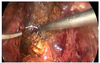Sutura de las paredes vesiculares creando una "nueva ves&iacute;cula" (t&eacute;cnica reconstructiva).