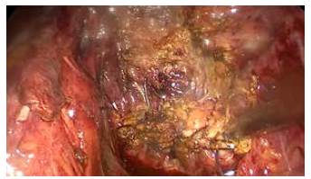 Aspecto Anal del nuevo mu&ntilde;&oacute;n vesicular. Clip en lecho vesicular, con ligadura alta de la arteria c&iacute;stica.