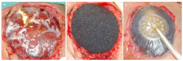 a. Pel&iacute;cula pl&aacute;stica con m&uacute;ltiples perforaciones. b. Ap&oacute;sito de poliuretano. c. Adhesivo transparente y sistema de vac&iacute;o