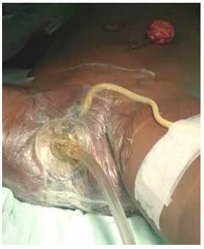 Sistema instalado en infecci&oacute;n de tejidos blandos perianal.