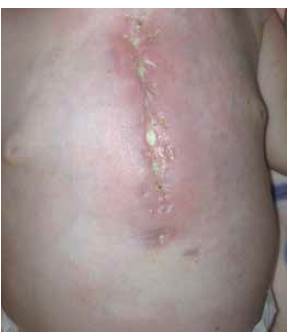 Infecci&oacute;n de esternotom&iacute;a.