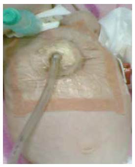 Sistema de presi&oacute;n negativa instalado en una herida del estern&oacute;n