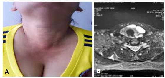 Malformaci&oacute;n linf&aacute;tica en cuello. A) Aspecto al examen f&iacute;sico donde se aprecia que la masa aumenta con las maniobras de Valsalva. B) Resonancia nuclear que muestra hipercaptaci&oacute;n de lesi&oacute;n linf&aacute;tica.