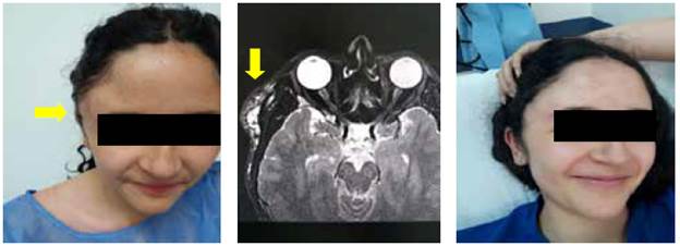 Paciente con malformaci&oacute;n vascular en regi&oacute;n temporal derecha con deformidad est&eacute;tica y dolor, manejada con alcohol absoluto v&iacute;a percut&aacute;nea. A) Aspecto previo a la intervenci&oacute;n. B) Resonancia magn&eacute;tica nuclear donde se aprecia la lesi&oacute;n. C) Aspecto de la paciente al segundo mes despu&eacute;s del tratamiento.