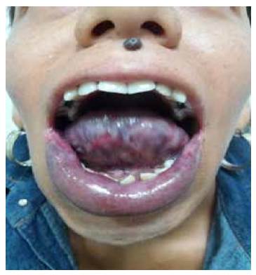 Paciente con f&iacute;stulas arteriovenosas en boca que generan deformaci&oacute;n de la cavidad oral y desplazamiento dental