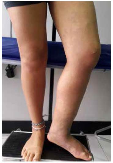 Paciente con s&iacute;ndrome de Klippel-Trenaunay (hemihipertrofia, manchas de vino oporto y malformaciones venolinf&aacute;ticas) con compromiso de miembro inferior izquierdo.