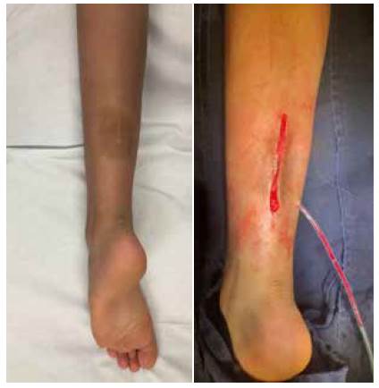 Glomangioma en pierna izquierda, que fue tratado con resecci&oacute;n quir&uacute;rgica amplia.