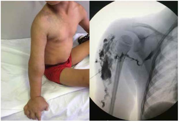 Paciente con lagos venosos malformados que drenan a vena profunda normal, manejado con alcohol y espirales de platino (coils).