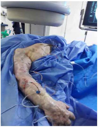 Paciente con m&uacute;ltiples malformaciones en brazo derecho, que recibi&oacute; punciones para inyecci&oacute;n de alcohol.