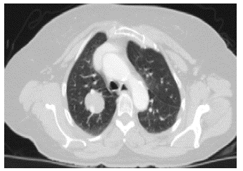 Tomografía computarizada de tórax donde se observa un nódulo en el lóbulo superior derecho.