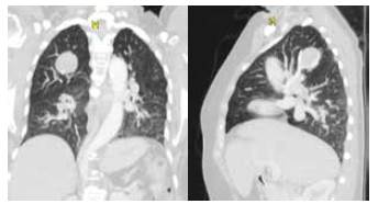 Tomografía de tórax donde se aprecia un nódulo en el lóbulo superior derecho y el drenaje anómalo de la vena superior derecha.