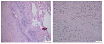 Lobectomía: Parénquima pulmonar adyacente al leiomioma. De izquierda a derecha, hematoxilina y eosina 4x y 20x.