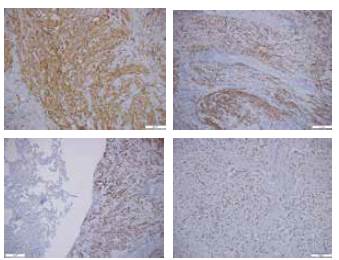 Lobectomía: Parénquima pulmonar adyacenteal leiomioma. De izquierda a derecha positividad para CD34 y H-caldesmon, desmina y progesterona.