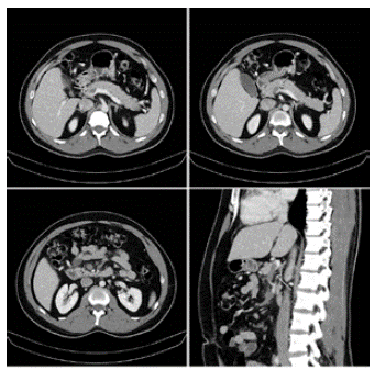 Estriaci&oacute;n de la grasa mesent&eacute;rica rodeando vasos mesent&eacute;ricos superiores, con trombosis de la vena mesent&eacute;rica superior y trombosis de la rama distal de la porta derecha en su rama anterosuperior.