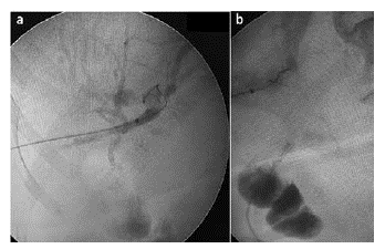(a) Colangiograf&iacute;a transparieto-hep&aacute;tica derecha (instrumentaci&oacute;n biliar percut&aacute;nea). (b) Punci&oacute;n del asa desfuncionalizada e inyecci&oacute;n de medio de contraste.