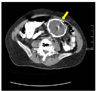 Tomografia computarizada de abdomen que documenta masa intraabdominal (flecha amarilla) en &iacute;ntimo contacto con tejidos retroperitoneales.