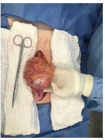 Teratoma dependiente del omento mayor.