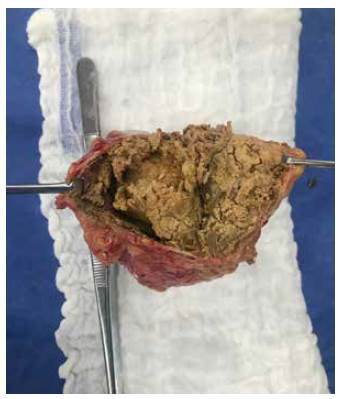 Al interior del teratoma se observa pelo y material seb&aacute;ceo.