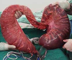 Se observa megadolicocolon con &aacute;reas hemorr&aacute;gicas y necrosis en varios segmentos y distensi&oacute;n importante en la resecci&oacute;n quir&uacute;rgica completa. 