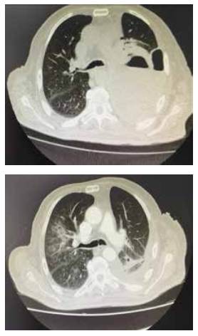 Colecci&oacute;n hidroa&eacute;rea compleja, de paredes gruesas, ocupando casi toda la extensi&oacute;n del hemit&oacute;rax izquierdo, con unos di&aacute;metros mayores de 28x14x10 cm (LxAPxT).