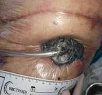 En la parte superior se observa la cicatriz de la toracotom&iacute;a posterolateral previa. En la parte inferior se observa la toracostom&iacute;a abierta en manejo con VAC.