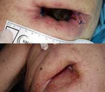 En la vista superior se aprecia la toracostom&iacute;a abierta con espacio pleural amplio y membranas fibrinopurulentas; en la vista inferior, la toracostom&iacute;a abierta despu&eacute;s del tercer cambio de VAC, donde se observa cierre progresivo y tejido de granulaci&oacute;n.