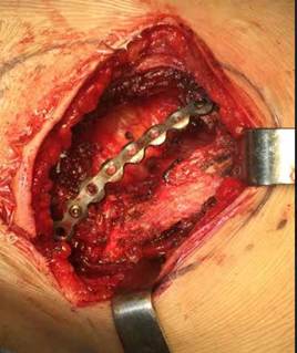 Caso 4. Paciente sometido a resecci&oacute;n de un arco costal y reconstrucci&oacute;n con una barra de titanio.