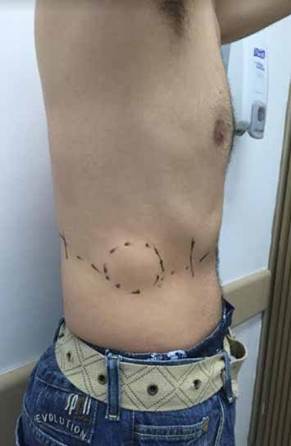 Caso 5. Paciente programado para resecci&oacute;n de la lesi&oacute;n con extracci&oacute;n de noveno y d&eacute;cimo arco costal con reconstrucci&oacute;n con dos barras de titanio. Resultado de patolog&iacute;a confirma fibromatosis de tipo desmoide.