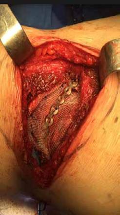 Caso 6. Paciente en quien se practic&oacute; resecci&oacute;n de un arco costal y reconstrucci&oacute;n con una barra de titanio y refuerzo con malla de Prolene