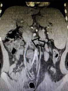 Corte coronal de tomografía de abdomen, donde se observa el cavernoma (flecha).