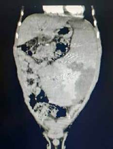 Esplenomegalia severa, que ocupa todo el hemi-abdomen izquierdo.
