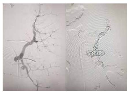 Arteriografía de la arteria esplénica. 4b. Embolización y oclusión completa de la arteria esplénica con onyx y coils.