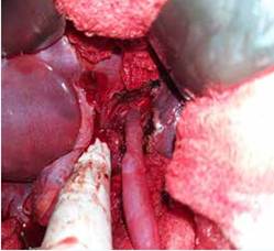 Anastomosis portal.