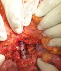 Anastomosis a la vena mesentérica superior.