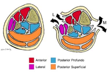 Compartimientos de la pierna y sus abordajes en fasciotomía: Se ilustran los cuatro compartimientos del miembro inferior. El abordaje medial permite liberar los compartimientos posterior y posterior profundo. El abordaje lateral permite liberar los compartimientos anterior y lateral.