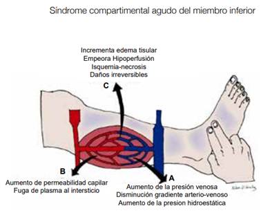 Principales eventos fisiopatológicos en el síndrome compartimental agudo: un aumento significativo de las presiones intracompartimentales ocasionan colapso venoso y alteración del gradiente arterio-venoso fisiológico con aumento subsecuente de la presión hidrostática capilar (A). Esto a su vez eleva la permeabilidad arterial, con subsecuente fuga plasmática al intersticio (B), lo cual termina por incrementar sostenidamente la presión intracompartimental hasta ocasionar isquemia, necrosis y daños irreversibles.