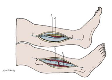Fasciotomía de la pierna: Se muestra el abordaje medial (1-2) y lateral (3-4) de la pierna. 1. Tibia. 2. El compartimiento posterior profundo en estrecho contacto con la Tibia. 3. Fasciotomía del compartimiento anterior. 4. Fasciotomía del compartimiento lateral.