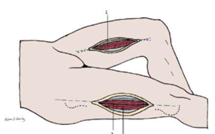 Fasciotomía del muslo: se muestra el abordaje medial (1) y el abordaje lateral del muslo (2-3). 1. Compartimiento medial. 2. Compartimiento anterior. 3. Compartimiento posterior.